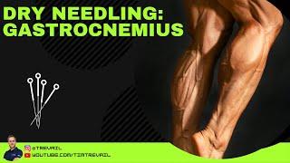 Dry Needling: Gastrocnemius