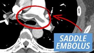 Emergency Radiology Case Series: Acute Diagnoses of the Chest