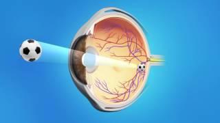 Cataract Surgery with a Toric Lens