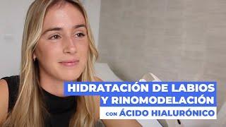 Hidratación de labios y rinomodelación con ácido hialurónico | Doctor Leo Cerud