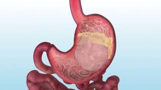 A New Non-Surgical Solution for Weight Loss - ORBERA™ Intragastric Balloon