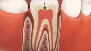 Why a Root Canal After a Crown - Sample CAESY Video