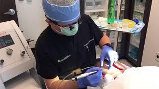 Follicular Unit Extraction Hair Transplant