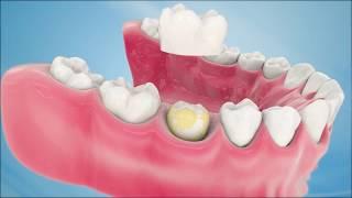 Dental Crown Procedure