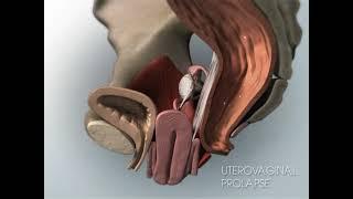 Animated female pelvic organ prolapse