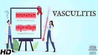 Vasculitis: Everything You Need To Know