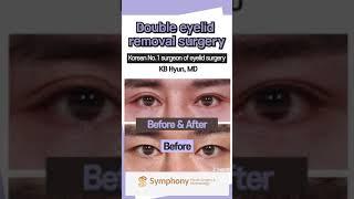 Lowering double eyelid crease (Asian monolids) cosmetic surgery before and after at Symphony