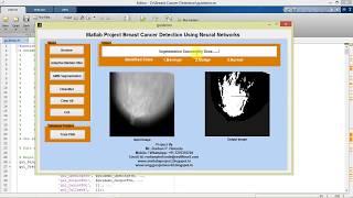 Breast Cancer Detection Using Neural Networks Matlab Project | Breast Cancer Prediction Using Matlab