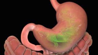 Stomach Ulcer | Nucleus Health