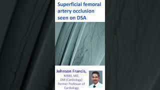 Superficial femoral artery occlusion seen on digital subtraction angiogram