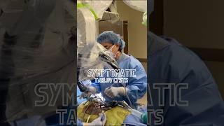 Tarlov Cyst Surgery in 60 Seconds