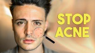 Stop Acne FAST! 5 Steps to beating acne FOREVER