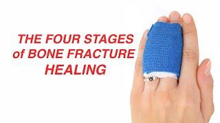 The Four Stages of Bone Fracture Healing