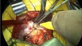 Dr.Thomas Gross-Hip Resurfacing-2006-Part 4