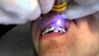 Disminucion inmediata de dolor ortodontico con Laser Quantum IR810