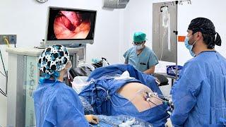 Dr. Miguel Montalvo Performing Gastric Sleeve with Hernia Repair