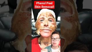 (TW) SHOCKING PHENOL PEEL Skin Removal #shorts