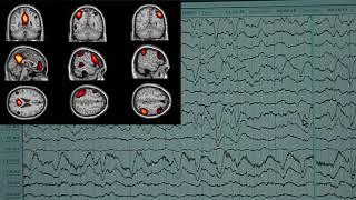 Why Can't We Define Coma and Does It Matter?