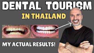 I Got 22 Crowns & 6 Veneers in Thailand  SHOCKING Dental Tourism Makeover