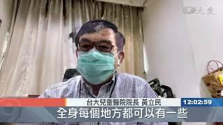 新冠病毒新發現 誘發末梢發炎腳腫脹