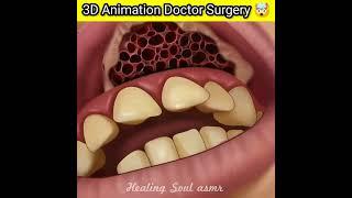 3D Animation Doctor infection surgery  ? #shorts #viral