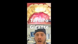  Tártaro ENORME - Sujeira Endurecida!! Remoção de Cálculo Dental