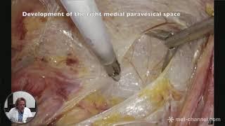 Laparoscopic bladder resection for deep infiltrating endometriosis by Dr.Marcello Ceccaroni, MD, PhD