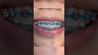 Orthodontie #shorts #viral