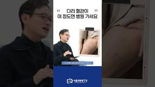 다리 혈관, 이 정도면 병원 가세요 #1분건강