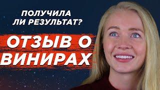 Отзыв о винирах №1. Носила БРЕКЕТЫ и мучалась..Виниры для зубов