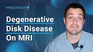 Degenerative Changes of the Lumbar Spine on MRI