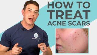 What do Experts Recommend for Acne Scars? | 208SkinDoc