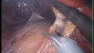 Mohling Diaphragm Endometriosis Excision