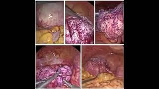 Laparoscopic Myomectomy for Fibroid Removal | Dr. Sushmita Mukherjee