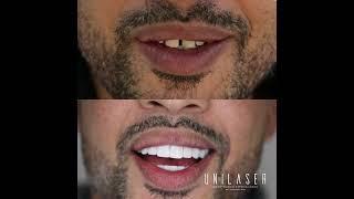 Close your dental gap with Unilaser!