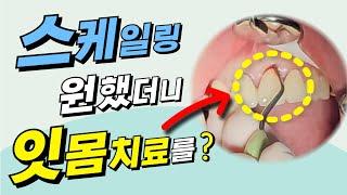 스케일링 받으러 치과 갔더니, 잇몸치료도 하라는데 왜?? #치석제거 #염증 #스케일링 #잇몸치료 #치과치료 #치과 #치과추천 #치과정보