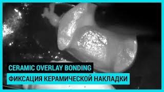 Ceramic overlay bonding. Фиксация керамической накладки