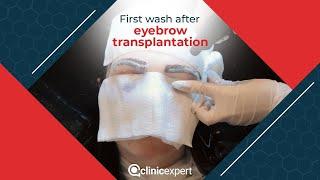 First wash after eyebrow transplantation