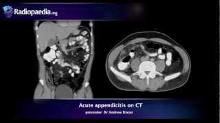 Acute appendicitis on CT - radiology video tutorial