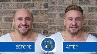 Before & After a Non-Surgical Hair Replacement System for Men (Hair Loss/Baldness)