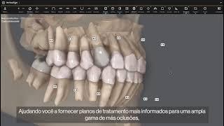 Invisalign + Tomografia