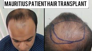 Best Hair transplant Mumbai | Hair transplant Review Mauritius Patient | The Hair and Shape Clinic