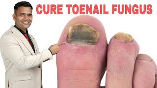 Best Toenail fungus Treatment Naturally | Cure Toe Nail Fungus at Home