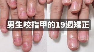 Boys severely bite nails - correct nails for 19 weeks, change the nail bed atrophy, fingerling