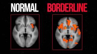 Como é o CÉREBRO de quem tem Transtorno de Personalidade Borderline?