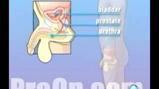 PreOp® Patient Education TURP Transurethral Resection Prostate Surgery 1