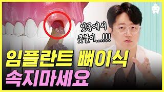 *제발 주의하세요!!* l 이 정보 모르고 치과 갔다간 남이 쓴 재활용 치조골 이식 받을지도 몰라요!!