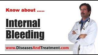 Internal bleeding (Internal Haemorrhage)  : Causes, Symptoms, Diagnosis, Treatment, Prevention