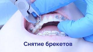 Снятие брекетов с зубов нижней челюсти |  ортодонтия влог | braces off