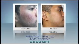 Get Rid of Acne Scars at South Coast MedSpa! (Vietnamese)